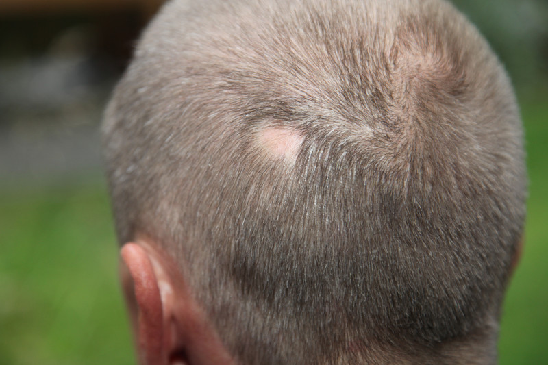 Hair loss - Symptoms and causes - Mayo Clinic